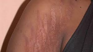 5 Effective Home Remedies For Getting Rid Of Stretch Marks