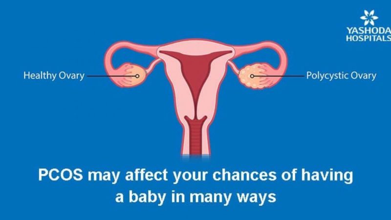 Polycystic ovary syndrome (PCOS) And Infertility