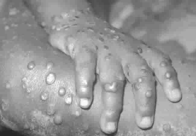 5 Things To Know About Monkeypox