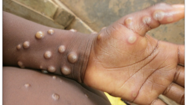 9 Cases Of Monkey Pox Confirmed In Abia State