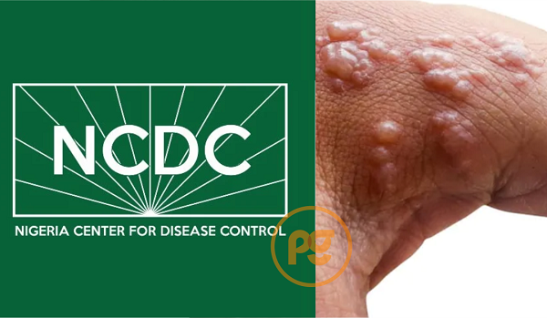 NCDC Confirms 157 Monkeypox Cases, 4 Deaths