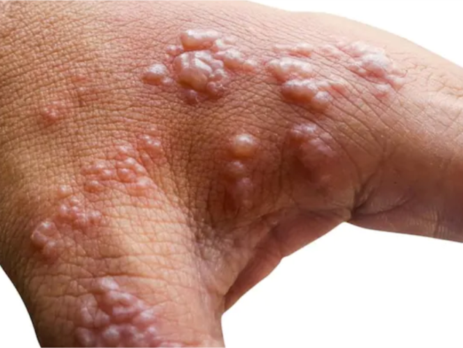 NCDC Reports 39 Mpox Cases in Nigeria, No Deaths